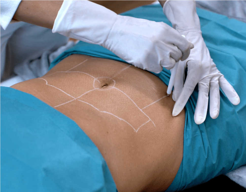 Průběh ošetření břicha metodou Endolift na&nbsp;klientce 45 let na&nbsp;klinice Formositas Praha