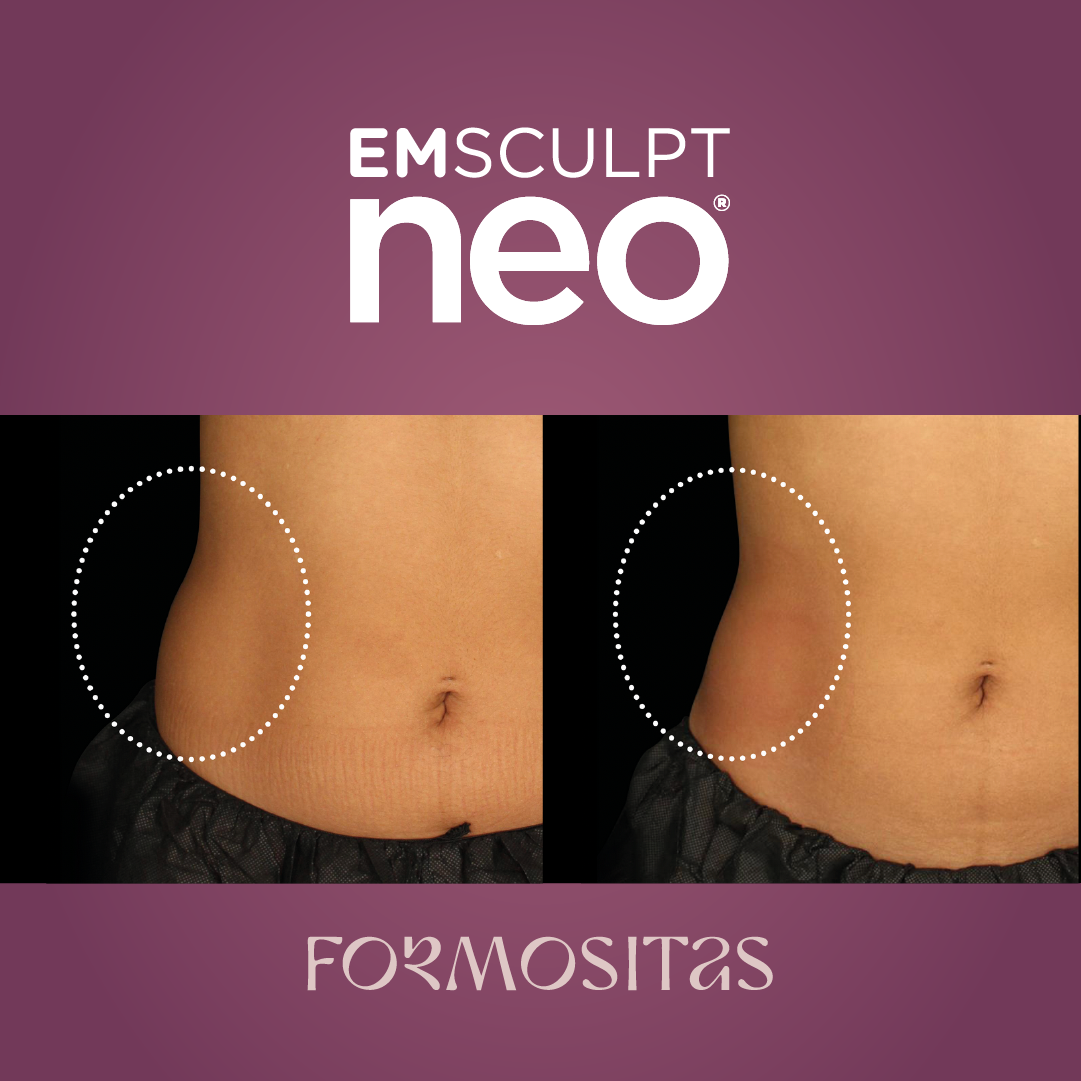EMSCULPT NEO vysledek result pred po before after