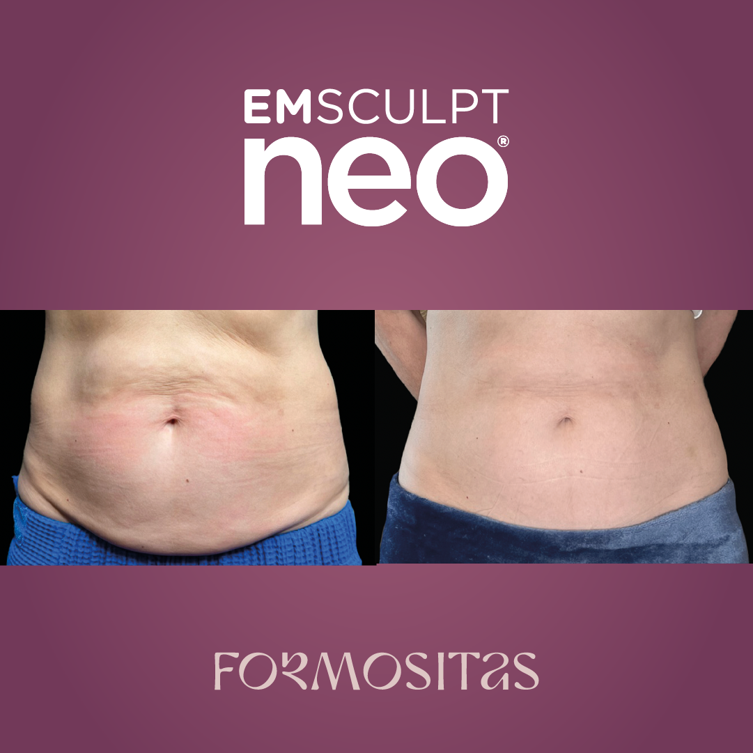 EMSCULPT NEO vysledek result pred po before after