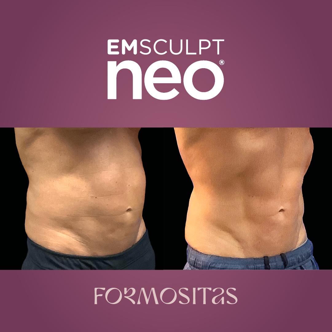 EMSCULPT NEO vysledek result pred po before after