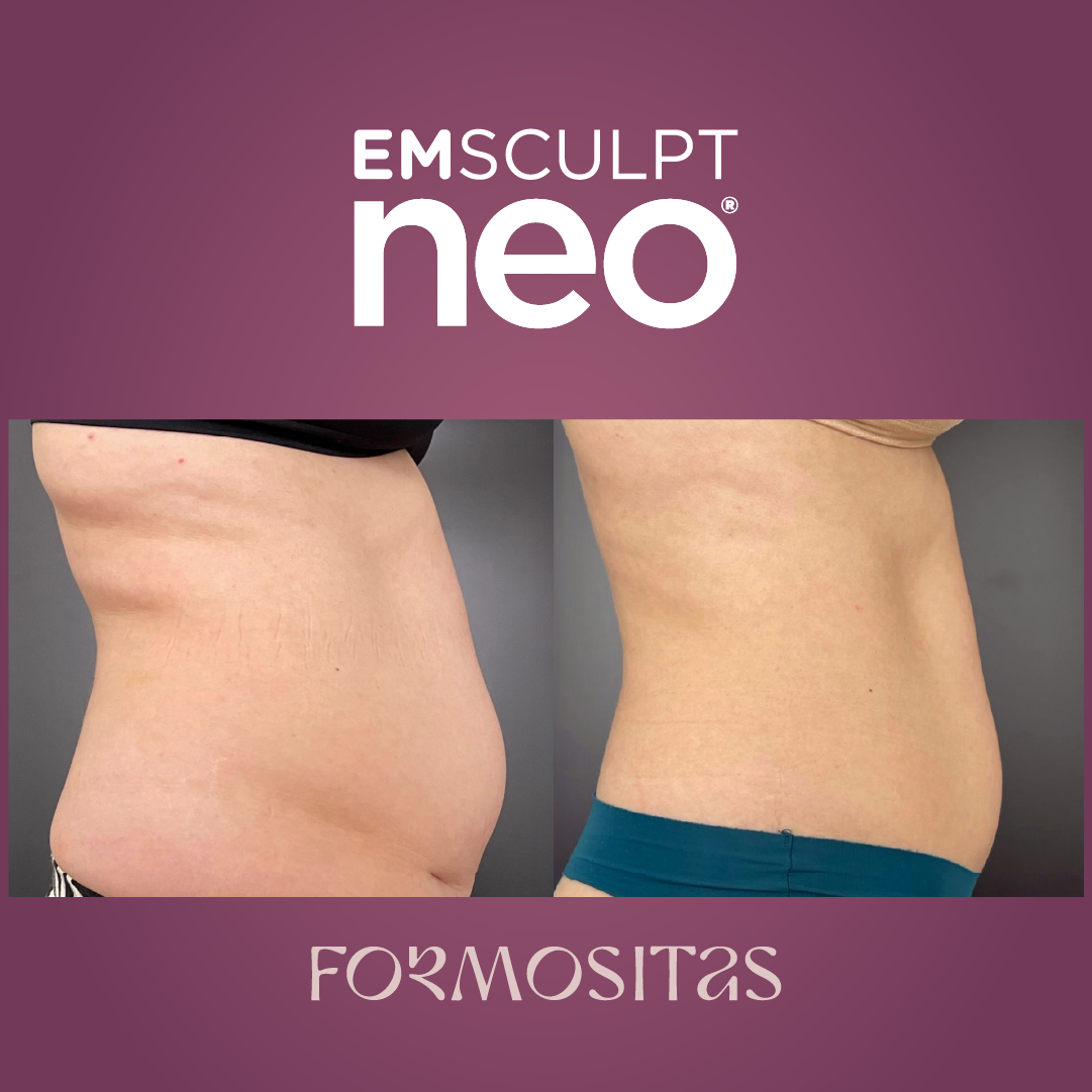 EMSCULPT NEO vysledek result pred po before after