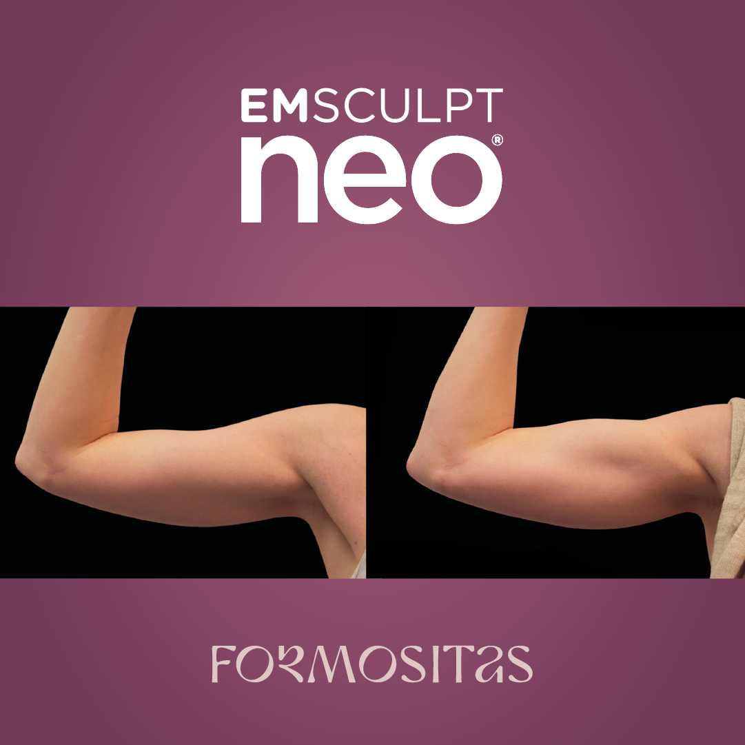 EMSCULPT NEO vysledek result pred po before after