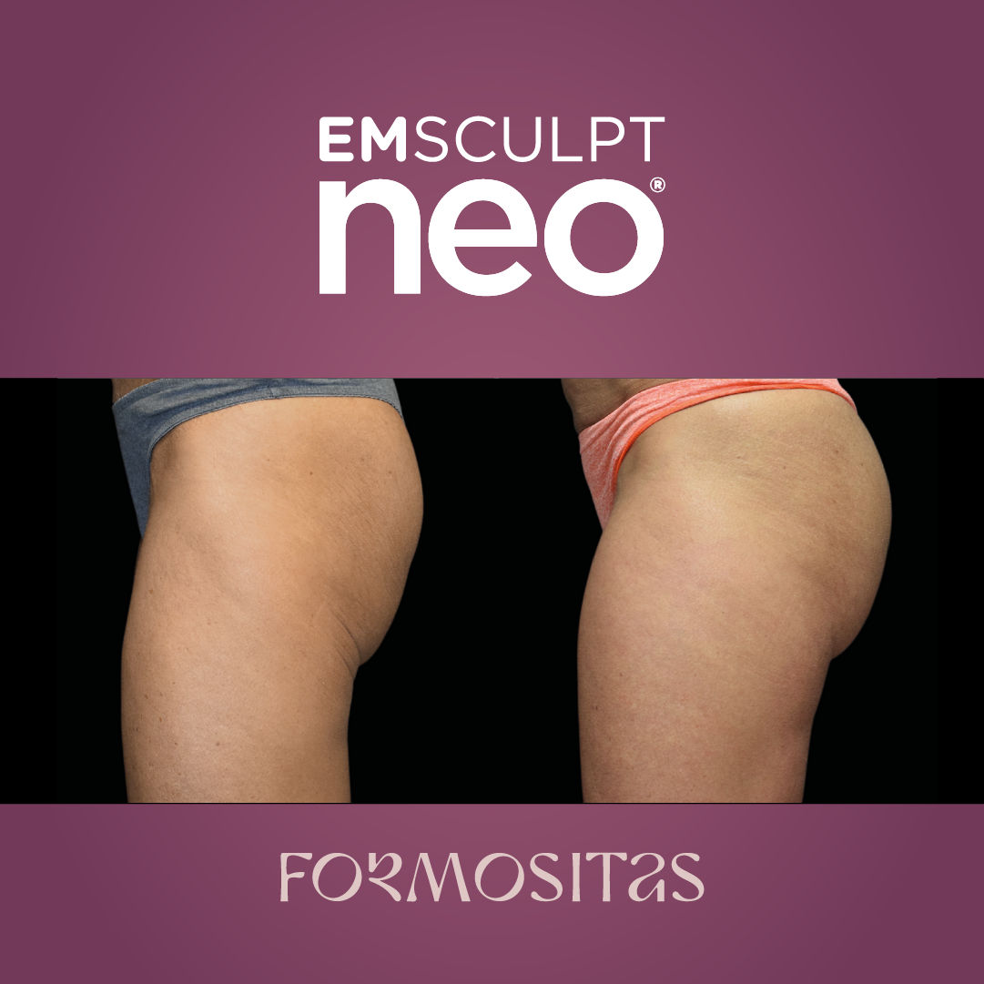 EMSCULPT NEO vysledek result pred po before after