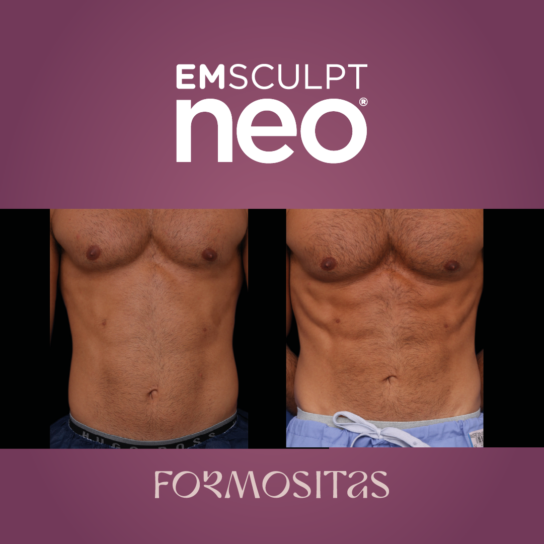 EMSCULPT NEO vysledek result pred po before after