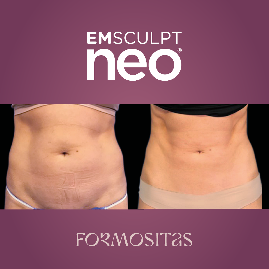 EMSCULPT NEO vysledek result pred po before after
