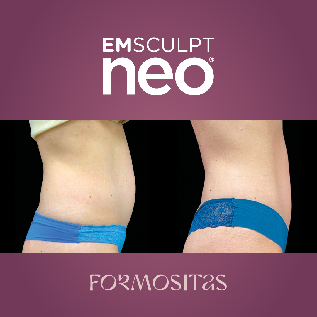EMSCULPT NEO vysledek result pred po before after